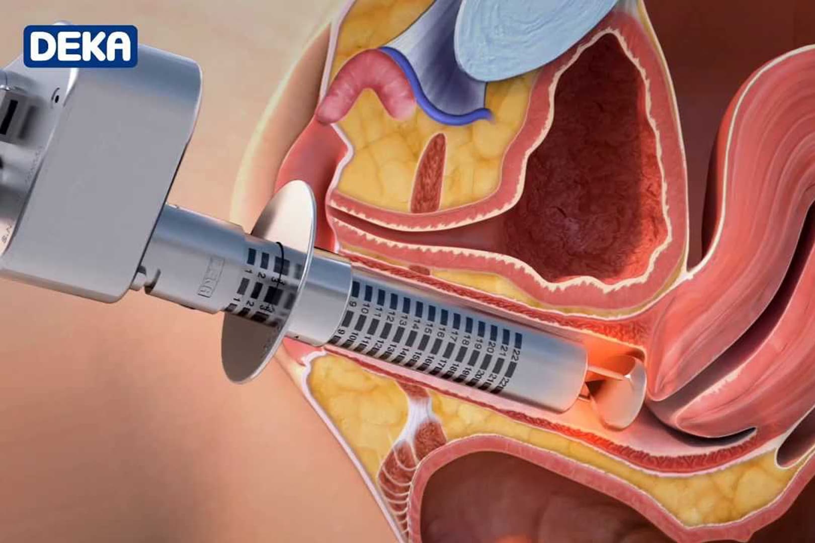 A 3D visual of the monalisa-procedure